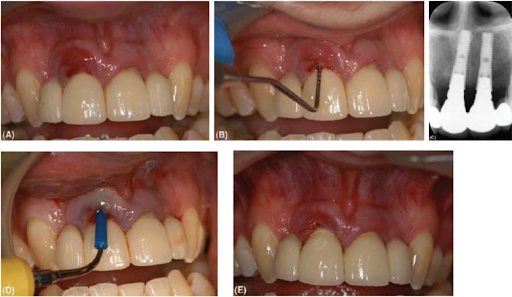 Tình trạng viêm mô mềm xung quanh implant