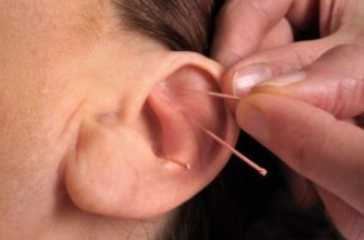 Phương pháp nhĩ châm điều trị mất ngủ