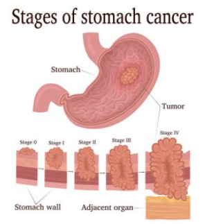 Các chỉ số xét nghiệm marker có thể cho biết nguy cơ mắc ung thư dạ dày của bệnh nhân