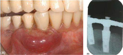 Sang thương nướu sưng đỏ, cứng, lan rộng