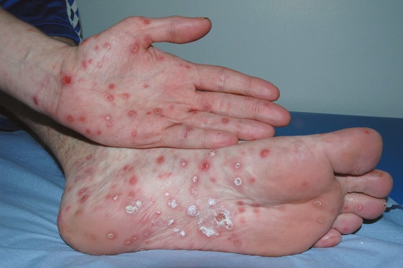 Triệu chứng chẩn đoán bệnh giang mai