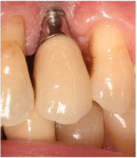 Thiếu hụt viền nướu tại vùng implant