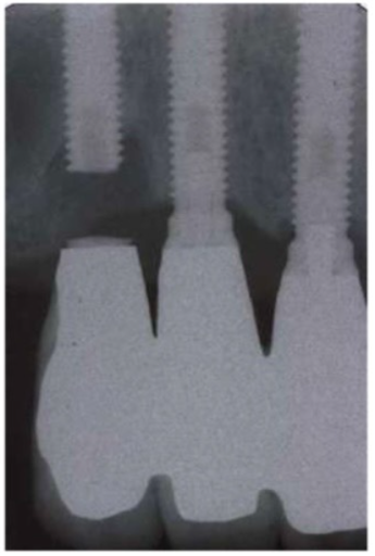 xquang cầu răng 3 đơn vị trên implant Brenmark chịu lực quá tải