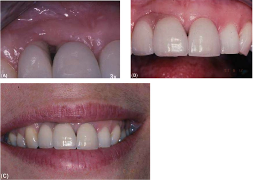 Răng cửa giữa và cửa bên hàm trên được thay thế bằng các implant