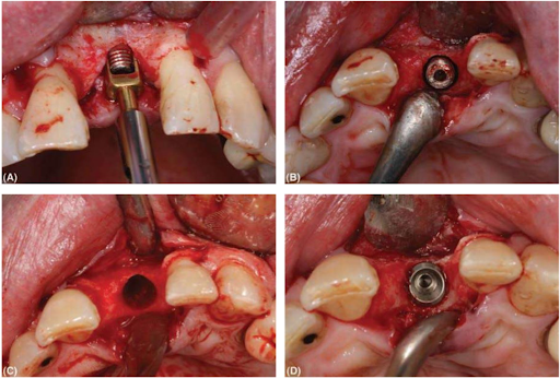 Quá trình tháo bỏ implant gãy