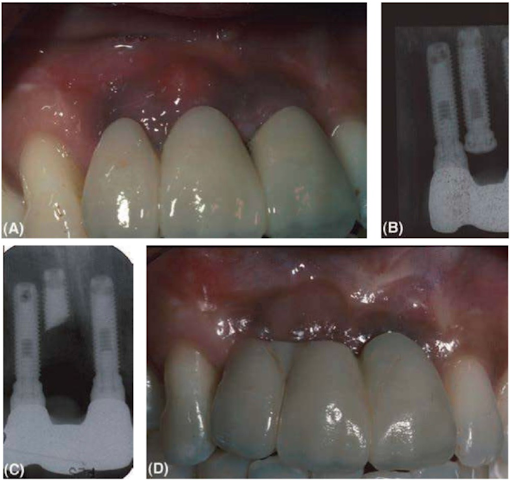 cầu răng ba đơn vị trên implant