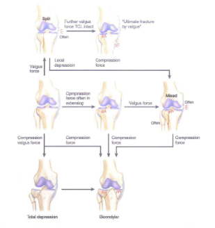Cơ chế chấn thương gãy mâm chày