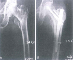 Gãy phức tạp khối mấu chuyển thân xương