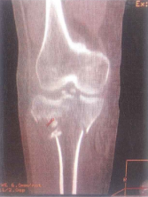 Cắt lớp vi tính gãy mâm chày