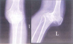 Một tổn thương trật khớp gối cũ không được điều trị