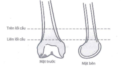 Phân chia đầu dưới xương đùi