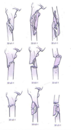 Phân độ gãy DMC AO/ OTA