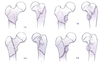 Phân loại gãy DMC theo Russell- Taylor