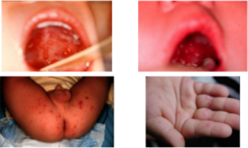 Triệu chứng lâm sàng bệnh tay chân miệng