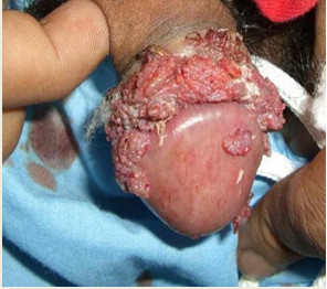 Sùi mào gà ở dương vật