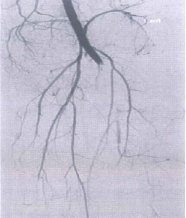 Tổn thương mạch khoeo trong trật khớp gối