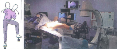 Tư thế bệnh nhân khi nắn chỉnh ổ gãy