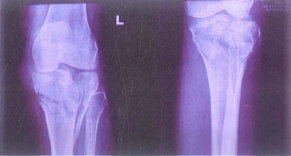 X-quang gãy mâm chày