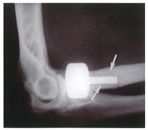 Thay chỏm quay nhân tạo