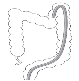 Ống soi cuộn đại tràng góc lách
