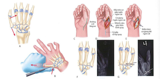 Kỹ thuật mổ gãy Bennett theo Wagner