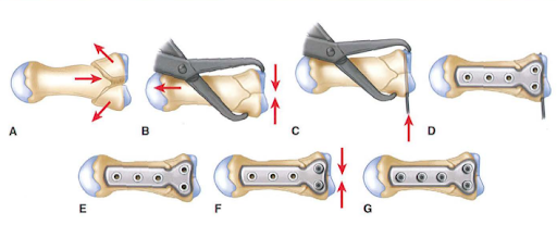 Kỹ thuật nắn chỉnh và cố định bằng nẹp vít mini cho gãy Ronaldo kiểu T