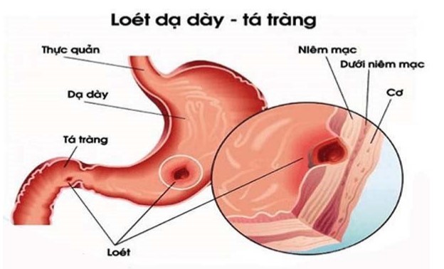 Loét dạ dày - tá tràng