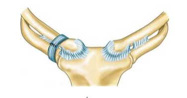 Trật khớp ức đòn: Cố định xương đòn vào xương sườn 1