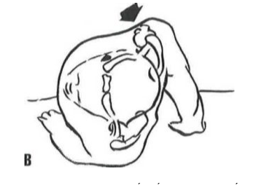 Trật khớp ức đòn: Cơ chế chấn thương gián tiếp B. Trật xương đòn ra trước