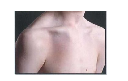 Trật khớp ức đòn