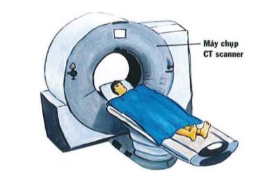 Chụp CT ngực trong trật khớp ức đòn