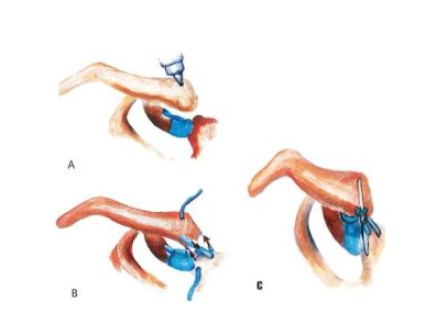 Trật khớp ức đòn