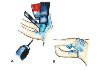 Trật khớp ức đòn: Kỹ thuật cắt đầu trong xương đòn
