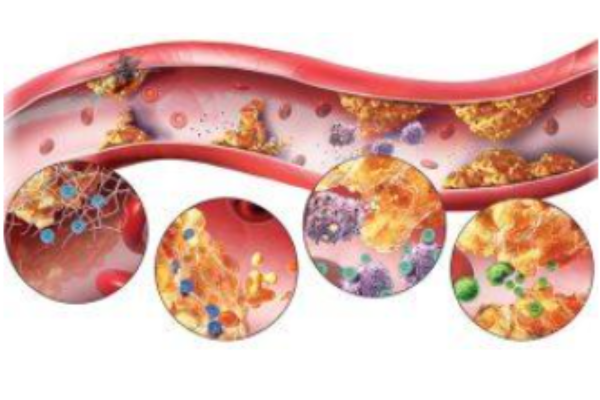 Các quá trình này dẫn đến hình thành mảng xơ vữa, tái cấu trúc thành mạch.