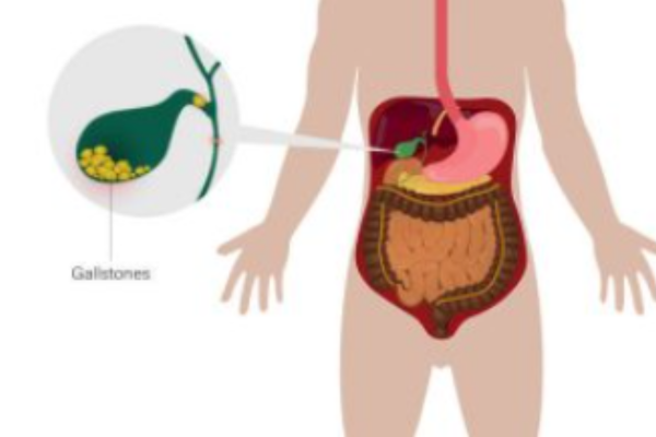 Dẫn lưu túi mật xuyên gan qua da (PTGBD) chỉ định cho viêm túi mật cấp mức độ trung bình và nặng