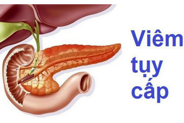 Thang điểm BISAP là một công cụ được sử dụng để đánh giá mức độ nghiêm trọng của viêm tụy cấp