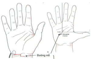Tư thế phẫu thuật