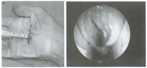 TCL đã cắt 1 phần và hoàn toàn