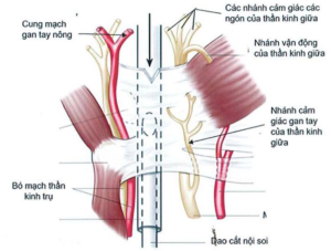 Các biến chứng có thể gặp phải khi phẫu thuật nội soi