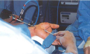 Đưa cannula vào ống cổ tay