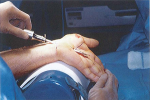 Đưa camera và dao cắt