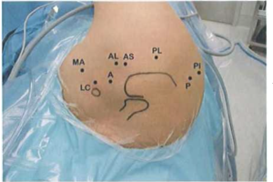 Phẫu thuật nội soi