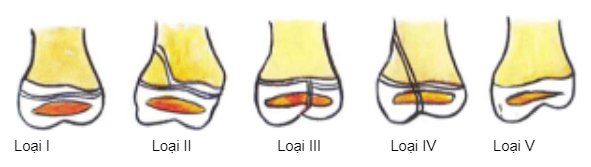 Phân loại gãy xương trẻ em theo Salter và Harris