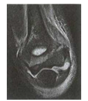 Hình ảnh MRI khớp khuỷu trong gãy LCN xương cánh tay trẻ em