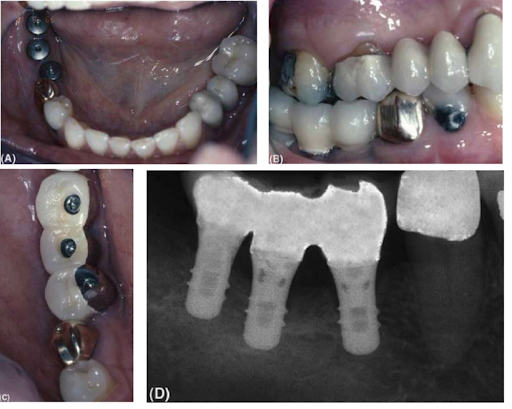 Thử, gắn và kiểm tra phục hình cầu răng trên Implant