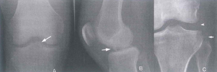 Tổn thương xương diện bám dây chằng trong trật khớp gối