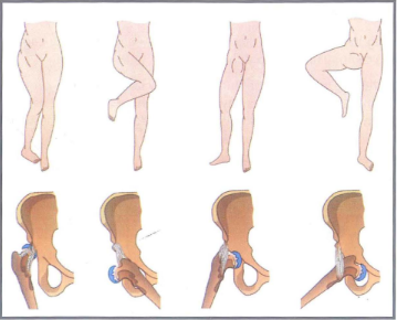 Các tư thế bắt buộc của chi dưới khi trật khớp háng