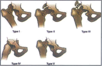 Các kiếu trật khớp háng ra sau