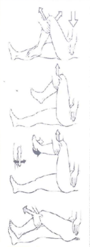 Nắn trật khớp háng theo phương pháp Allis