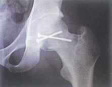 Sau mổ vít xốp gãy chỏm xương đùi